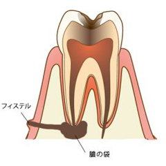 根管治療 狭山市の歯医者 あおば歯科