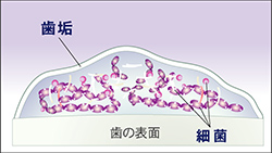 歯周病治療