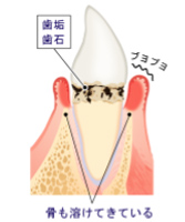 歯周病治療