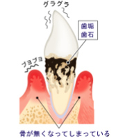 歯周病治療