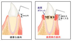歯周病治療