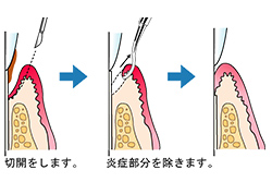歯周病治療